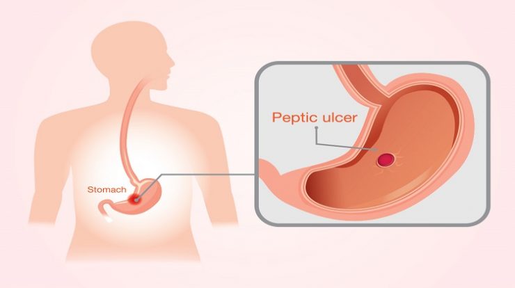 peptic ulcers
