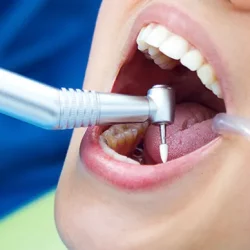 root canal treatment in Gurgaon